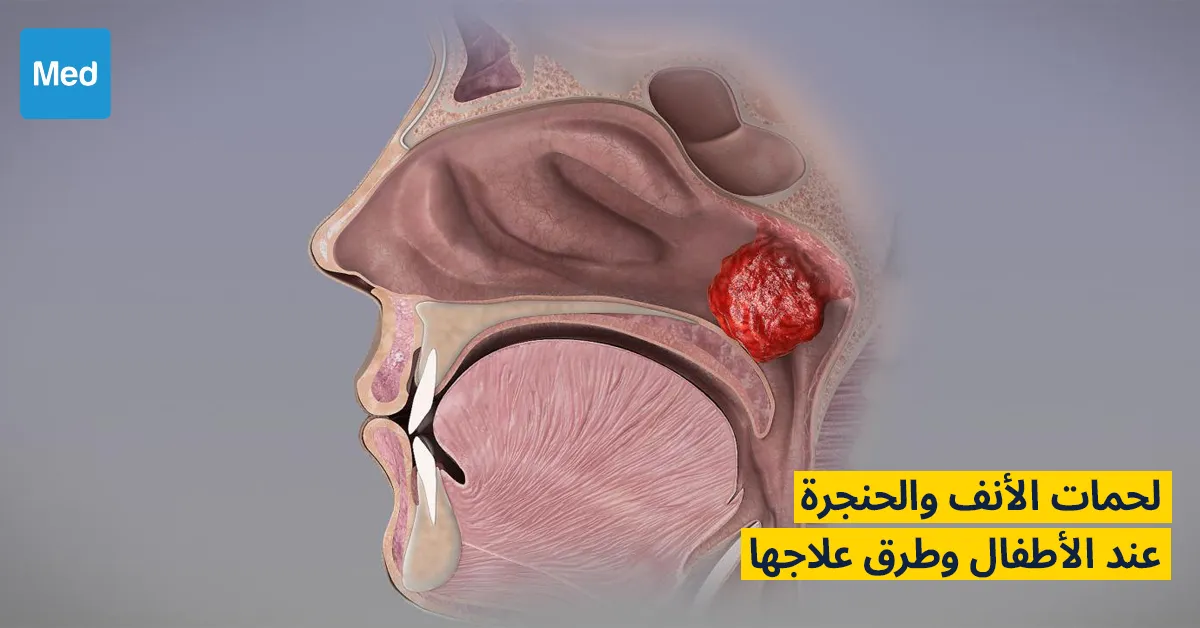 لحمات الأنف والحنجرة وطرق علاجها